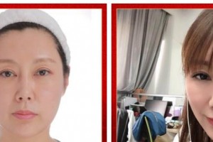 廣西醫(yī)科大學(xué)美容整形中心黎凍整形價(jià)格表附埋線提升案例展示