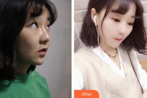廣西中醫(yī)藥大學附屬瑞康醫(yī)院整形美容中心郭應信整形價格表附切開雙眼皮案例展示