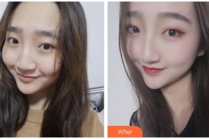 廣西醫(yī)科大學第一附屬醫(yī)院整形美容科梁自乾整形價格表附激光祛斑案例展示