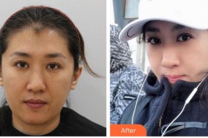 武警廣西總隊醫(yī)院醫(yī)學整形美容中心陳嘉莉整形價格表附清潔祛痘案例展示