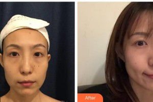 武警廣西總隊醫(yī)院醫(yī)學整形美容中心雷素龍整形價格表附去痘印痘坑案例展示