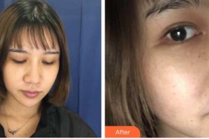 武警廣西總隊醫(yī)院醫(yī)學整形美容中心王玉燕整形價格表附去痘印痘坑案例展示