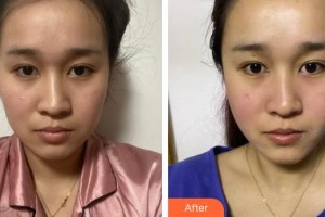 廣西愛思特整形外科醫(yī)院劉慶豐整形價格表附埋線提升案例展示