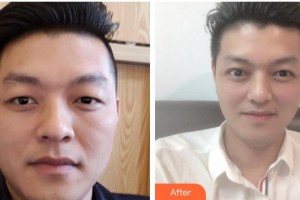 柳州愛爾眼科醫(yī)院陳振文整形價(jià)格表附切開雙眼皮案例展示