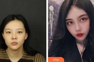 桂林市人民醫(yī)院眼科張玉明整形價格表附眼部綜合案例展示