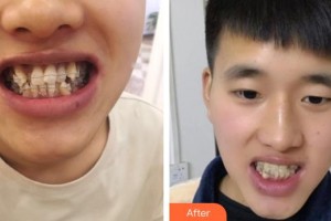 梧州華美整形美容醫(yī)院孔華鋒整形價格表附隱形托槽矯正案例展示