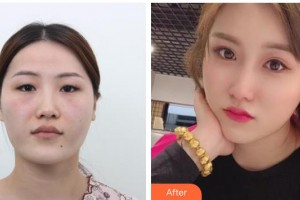欽州市第一人民醫(yī)院醫(yī)療整形美容激光中心劉良整形價格表附切開雙眼皮案例展示