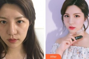 玉林愛爾眼科醫(yī)院盧榮強(qiáng)整形價格表附眼部修復(fù)案例展示