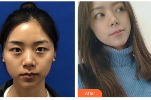 玉林愛爾眼科醫(yī)院區(qū)顯寧整形價格表附眼部綜合案例展示