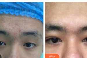 玉林愛爾眼科醫(yī)院羅志紅整形價格表附開內(nèi)眼角案例展示