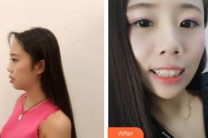 江陰牙博士口腔門診部孫陽整形價(jià)格表附牙齒隱形矯正案例展示