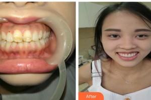 江陰牙博士口腔門診部裴洪來整形價(jià)格表附美白貼片案例展示