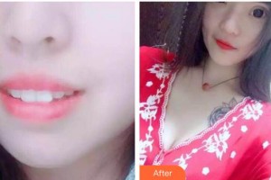 江陰牙博士口腔門診部張瑞杰整形價(jià)格表附牙齒隱形矯正案例展示