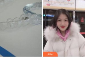 江陰牙博士口腔門診部林曉整形價(jià)格表附牙齒隱形矯正案例展示