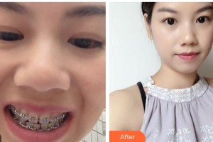 江陰牙博士口腔門診部范坤鵬整形價(jià)格表附金屬托槽矯正案例展示