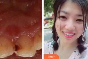 江陰牙博士口腔門診部宋旭杰整形價(jià)格表附美容冠案例展示