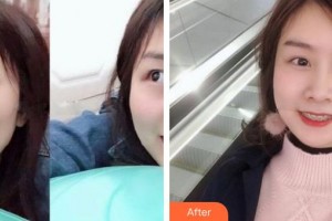 江陰金誠口腔門診部馬泉生整形價(jià)格表附金屬托槽矯正案例展示