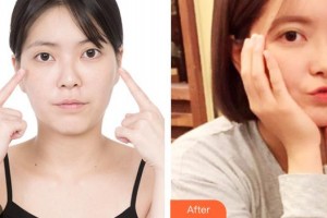 海南眼科醫(yī)院龍登虹整形價格表附開內眼角案例展示