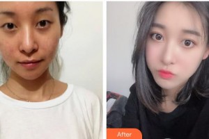 海南眼視光學中心門診部李加青整形價格表附開內眼角案例展示