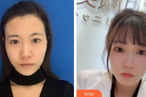 ?？跂|湖醫(yī)學美容整形醫(yī)院張文其整形價格表附去痘印痘坑案例展示