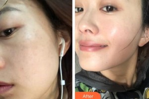 ?？邬i愛醫(yī)療美容醫(yī)院任秀麗整形價格表附激光祛斑案例展示