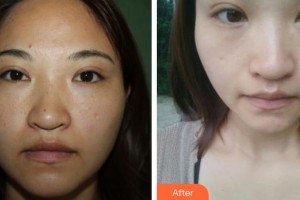 ?？谑械谒娜嗣襻t(yī)院眼科鐘羽麗整形價格表附清潔祛痘案例展示