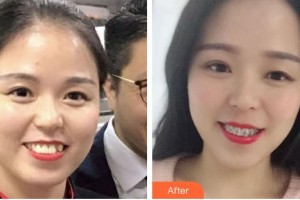 ?？诤佳谰S信口腔門診部李娜住院醫(yī)師整形價格表附自鎖托槽矯正案例展示
