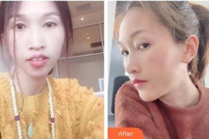 海口德恩口腔門診部朱平整形價格表附金屬托槽矯正案例展示