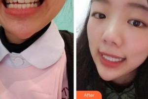 ?？诤佳谰S信口腔門診部樸光裕整形價格表附隱形托槽矯正案例展示