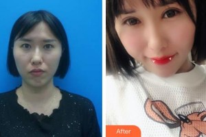 ?？诩t妝尚醫(yī)療美容門診部羅勇整形價格表附內切祛眼袋案例展示
