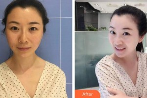 ?？诩t妝尚醫(yī)療美容門診部李楠整形價格表附埋線提升案例展示