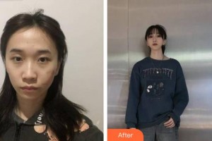 荊州華美整形美容醫(yī)院董巖巖整形價格表附微創(chuàng)疤痕修復(fù)案例展示
