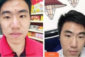 荊州市第二人民醫(yī)院整形激光美容中心劉兵整形價格表附紅藍(lán)光祛痘案例展示
