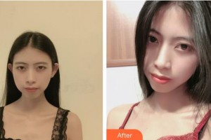 荊州華美整形美容醫(yī)院王懿整形價格表附去痘印痘坑案例展示