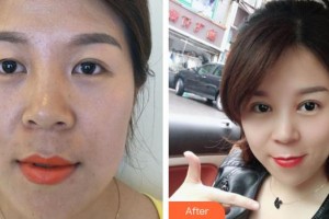 荊州市婦幼保健院眼科駱駿整形價格表附切開雙眼皮案例展示