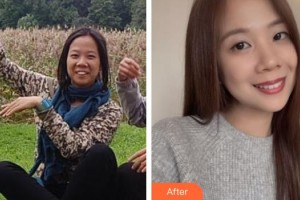 黃岡皓雅口腔醫(yī)院聶典整形價格表附牙齒隱形矯正案例展示