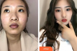 咸寧安美醫(yī)療美容門診部李愛林整形價格表附埋線提升案例展示