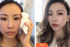 孝感仁愛醫(yī)院美容整形中心金日炫整形價格表附埋線提升案例展示