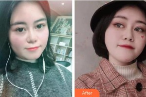 孝感歐陽整形美容診所嚴飛整形價格表附埋線提升案例展示