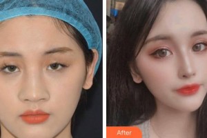 孝感愛爾眼科醫(yī)院魏淑明整形價格表附眼部綜合案例展示