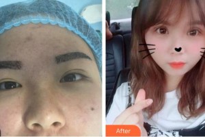 武漢艾格眼科醫(yī)院段淯平整形價格表附切開雙眼皮案例展示