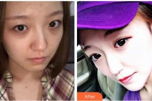 武漢艾格眼科醫(yī)院劉新榮整形價格表附開外眼角案例展示