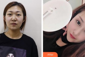 武漢艾格眼科醫(yī)院董艷霞整形價格表附切開雙眼皮案例展示