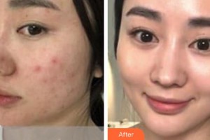 黃石華中?？滇t(yī)院（華中.華美）張智珍整形價(jià)格表附黃金微針案例展示