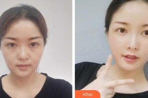 黃石華中?？滇t(yī)院（華中.華美）曹英武整形價(jià)格表附埋線提升案例展示