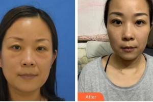 黃石愛爾眼科醫(yī)院喻杰整形價格表附激光去眼袋案例展示