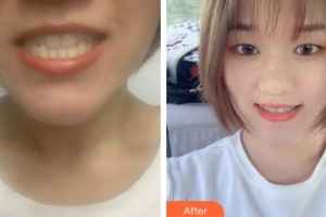 黃石春天口腔門診部馮懷玉整形價格表附牙齒隱形矯正案例展示