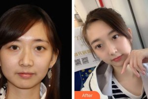 十堰陽光整形醫(yī)院黃金井整形價(jià)格表附熱瑪吉案例展示