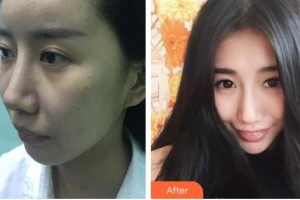 十堰梵媞醫(yī)學(xué)美容門診部李小燕整形價(jià)格表附埋線提升例展示