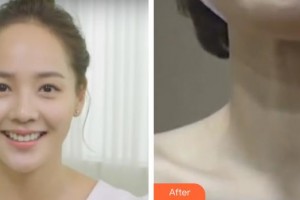 十堰陽光整形醫(yī)院邱銀先整形價(jià)格表附微針去頸紋案例展示